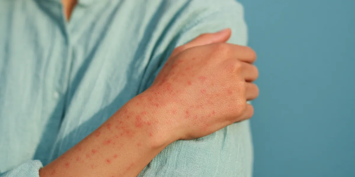 alergia pokarmowa skórne skutki