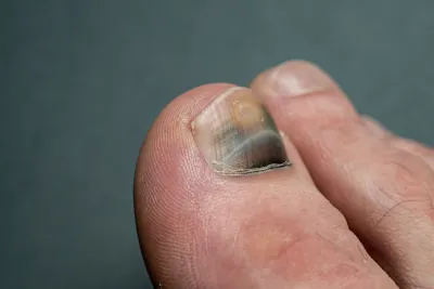 Czerniak paznokcia – przyczyny, objawy i leczenie