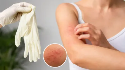 Jakie objawy daje uczulenie na lateks i jak walczyć z alergią?